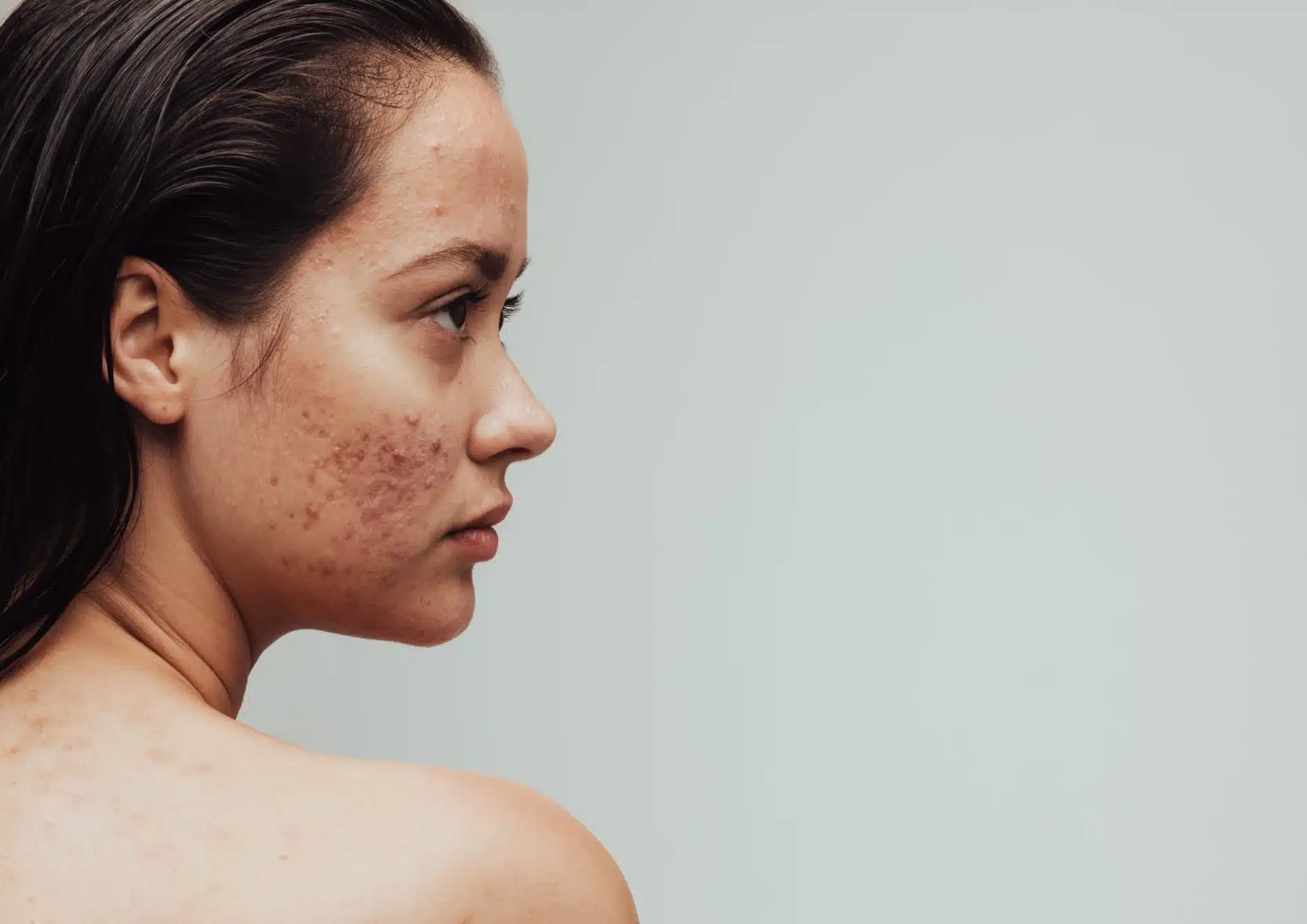 Acné : causes et traitements | Peeling cicatrices acné | Centre esthétique Skinessence | Paris