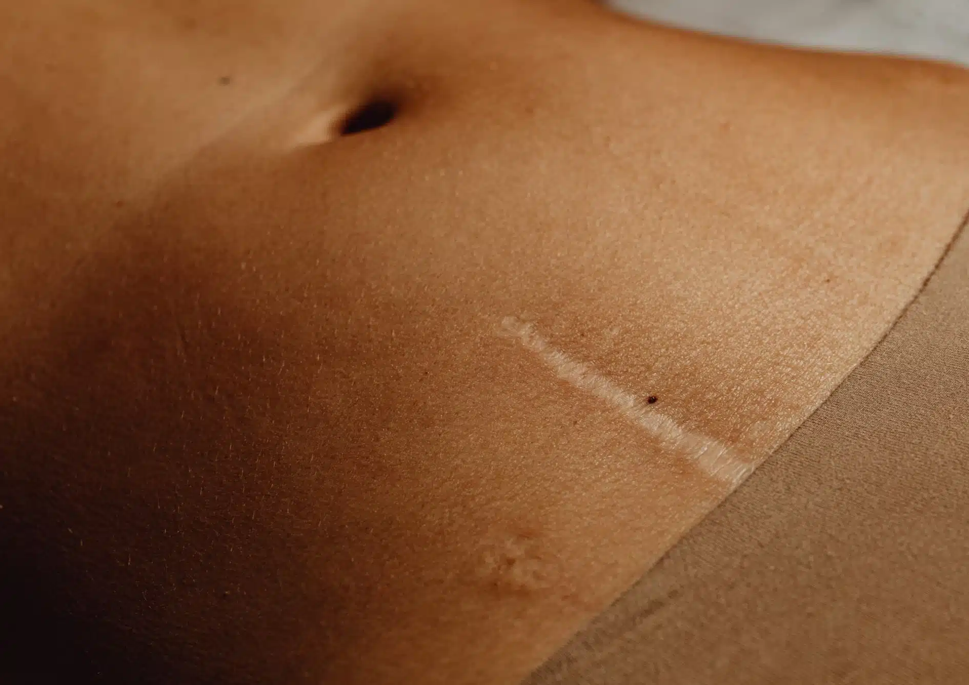 Cicatrices : causes et traitements | Traitement laser cicatrice | Centre esthétique Skinessence | Paris