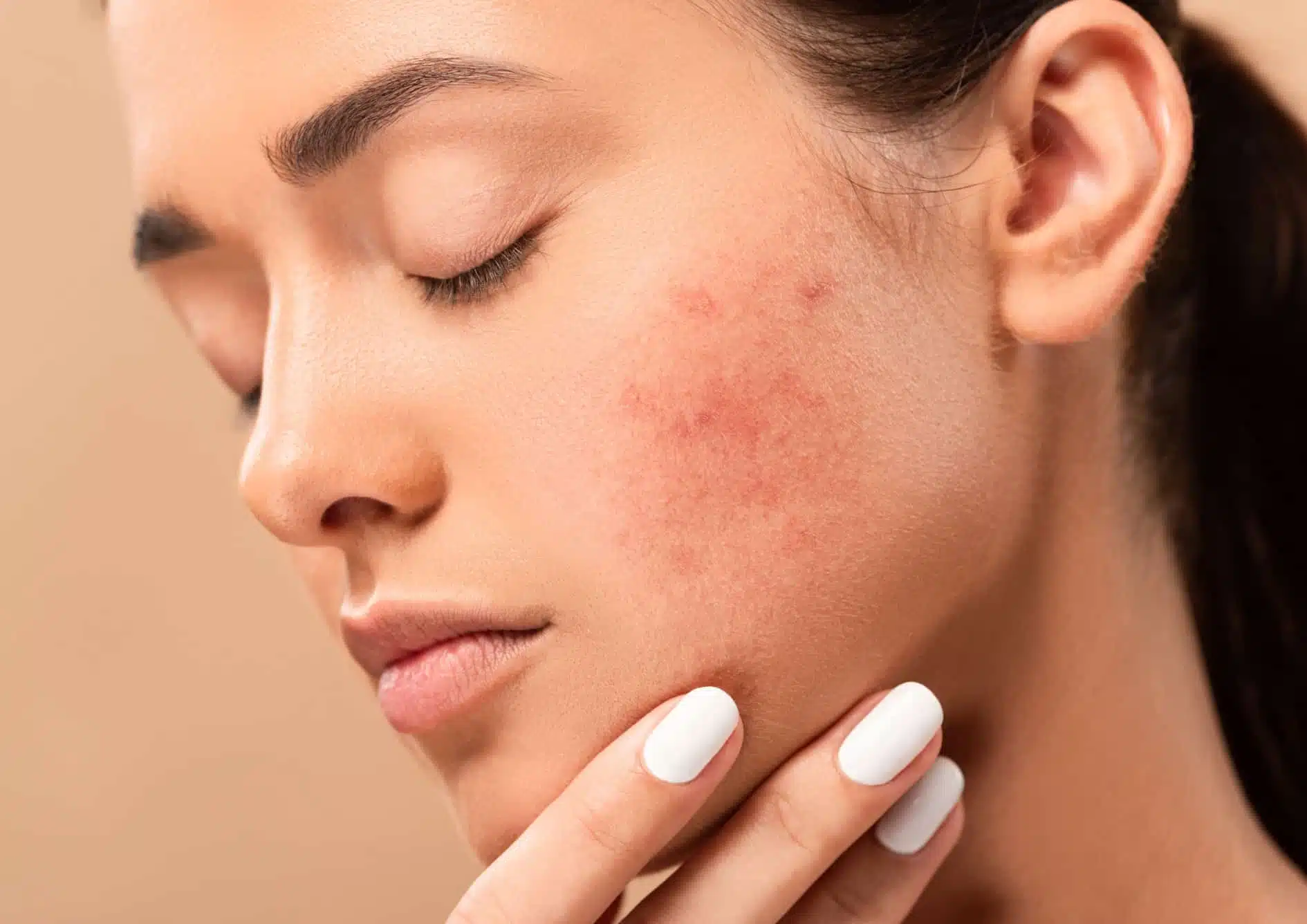 Couperose : causes et traitements | Traitement laser couperose | Centre esthétique Skinessence | Paris