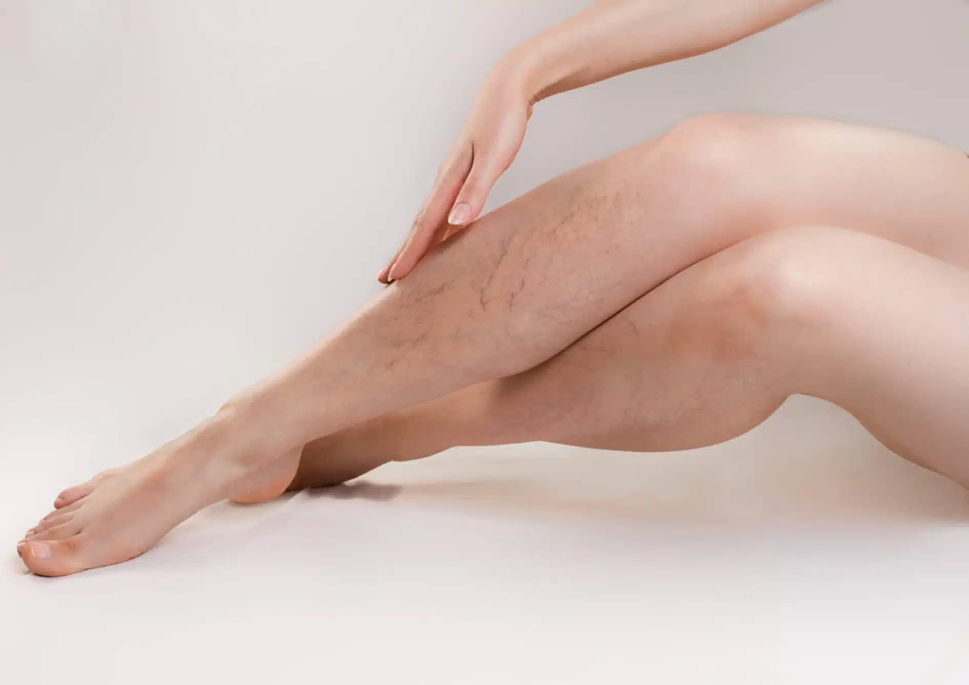 Varicosité : causes et traitements | traitement varicosités laser | Centre esthétique Skinessence | Paris