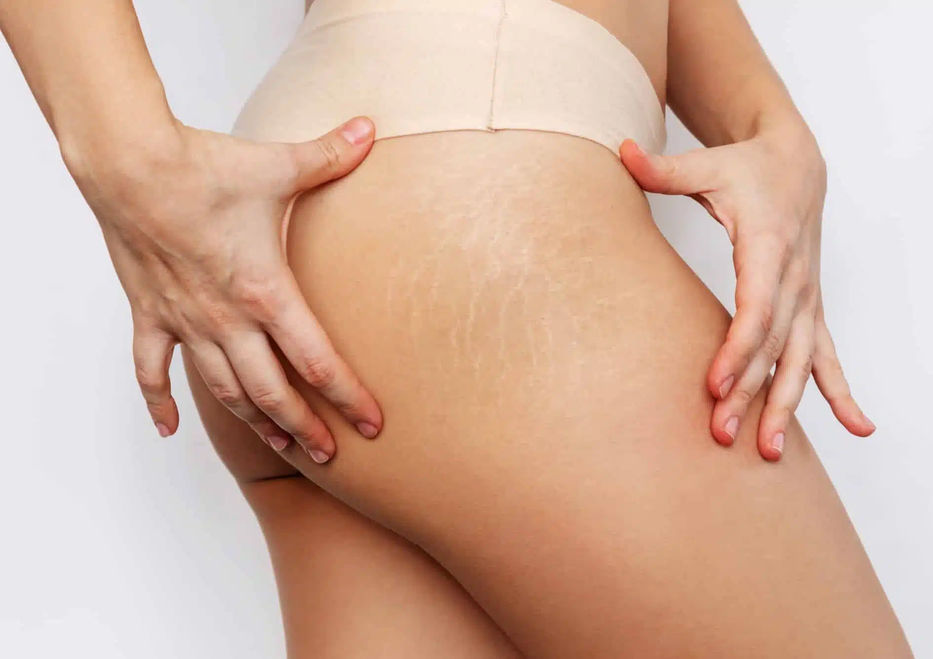 Vergetures : causes et traitements | Traitement laser vergetures | Centre esthétique Skinessence | Paris